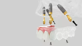 上顎の歯列欠損で部分床義歯を使用。 上顎の歯列欠損で部分床義歯を使用。